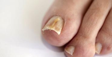 Симптомы и лечение грибка ногтей рук и ног